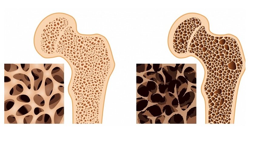 Что такое пятнистый остеопороз